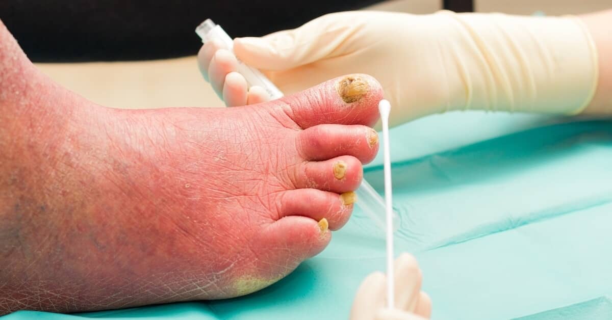 The Growing Threat of Fungal Infections about ComfortPro