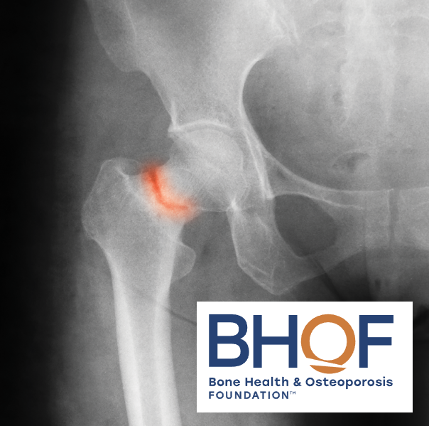 Hip X-ray